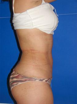 After Results for Liposuction