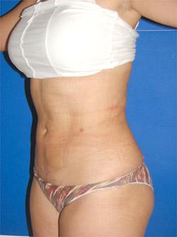 After Results for Liposuction