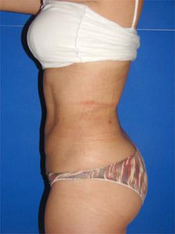 After Results for Liposuction