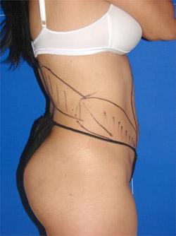 Before Results for Liposuction