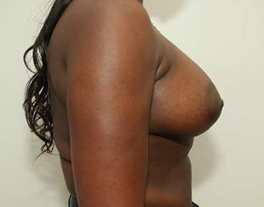 After Results for Breast Augmentation