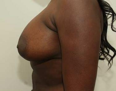 After Results for Breast Augmentation