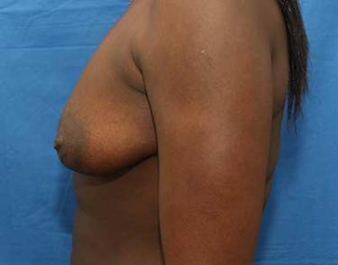 Before Results for Breast Augmentation