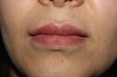 After Results for Tissue Fillers, Lip Augmentation