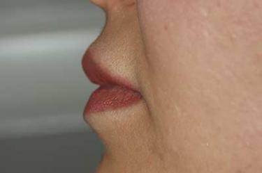 After Results for Lip Augmentation