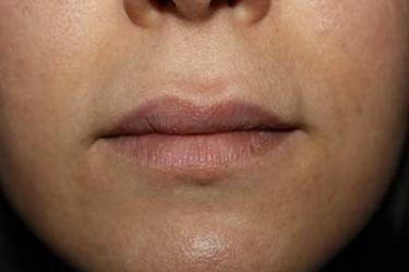 Before Results for Lip Augmentation