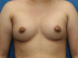 After Results for Breast Augmentation