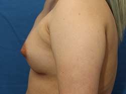 After Results for Breast Augmentation