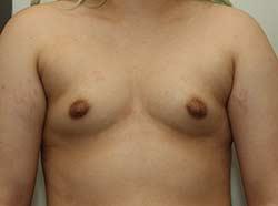 Before Results for Breast Augmentation