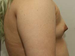 Before Results for Breast Augmentation