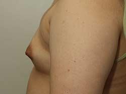 Before Results for Breast Augmentation