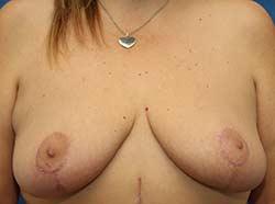 After Results for Breast Lift / Mastopexy