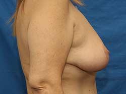 After Results for Breast Lift / Mastopexy