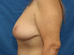 After Results for Breast Lift