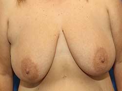 Before Results for Breast Lift / Mastopexy