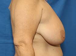 Before Results for Breast Lift