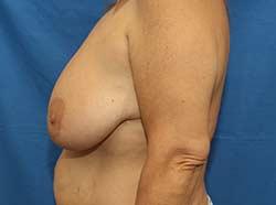 Before Results for Breast Lift