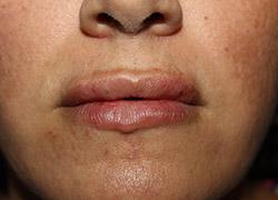 After Results for Tissue Fillers, Lip Augmentation