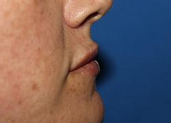 After Results for Tissue Fillers, Lip Augmentation