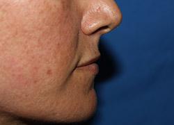 Before Results for Tissue Fillers, Lip Augmentation