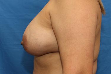 After Results for Breast Augmentation