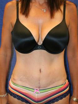 After Results for Liposuction, Tummy Tuck