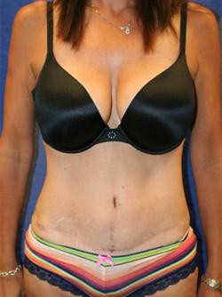 Best Tummy Tuck San Antonio - Abdominoplasty