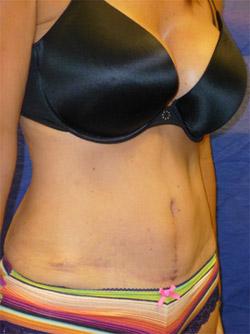 After Results for Liposuction, Tummy Tuck
