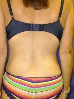 After Results for Liposuction