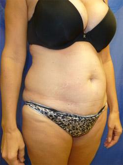 Before Results for Tummy Tuck