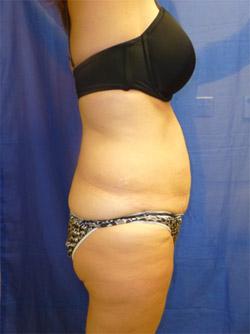 Before Results for Liposuction