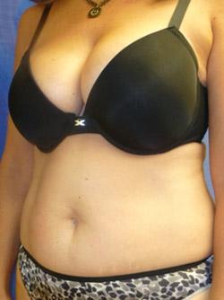 Before Results for Tummy Tuck