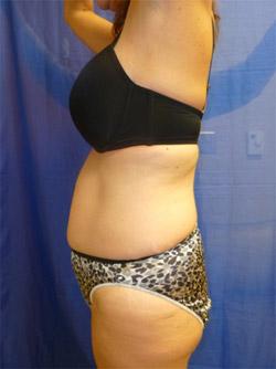 Before Results for Tummy Tuck