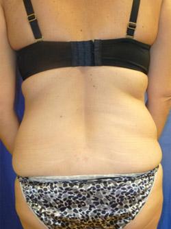 Before Results for Liposuction