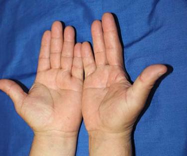 After Results for Hand Surgery