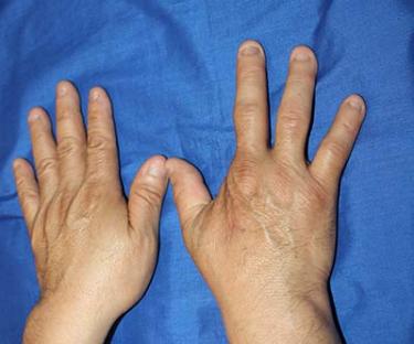 After Results for Hand Surgery