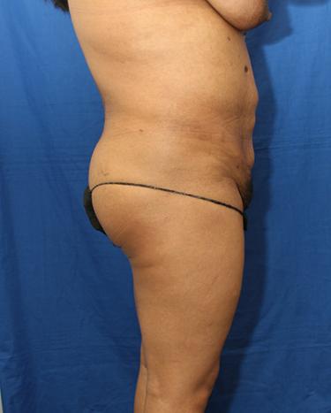 After Results for Liposuction, Gluteal Augmentation