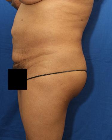 After Results for Liposuction