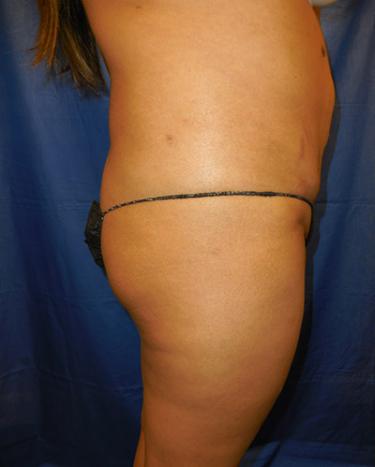 Before Results for Gluteal Augmentation