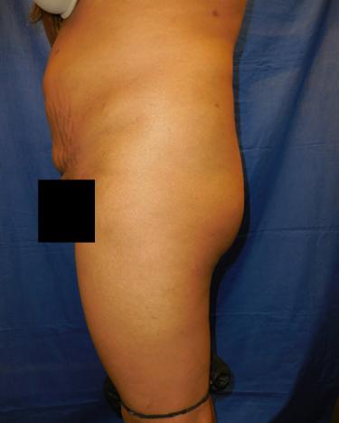 Before Results for Liposuction