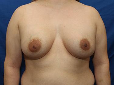 After Results for Breast Augmentation