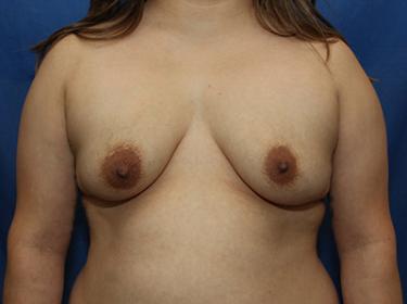 Before Results for Breast Augmentation