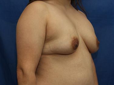 Before Results for Breast Augmentation