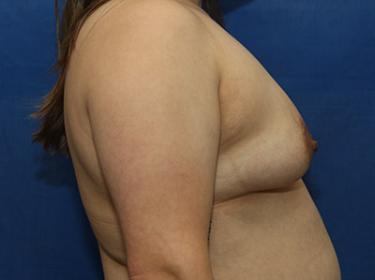 Before Results for Breast Augmentation