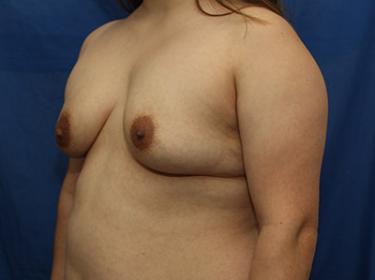 Before Results for Breast Augmentation