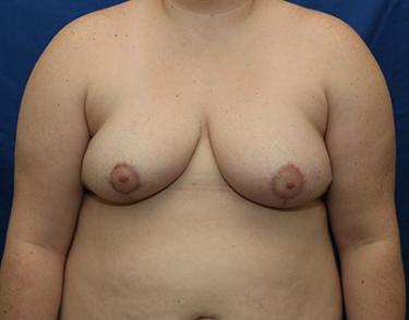 After Results for Breast Reduction