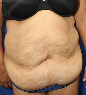 Before Results for Panniculectomy