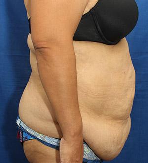 Before Results for Panniculectomy