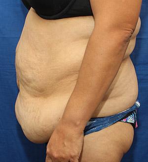 Before Results for Panniculectomy