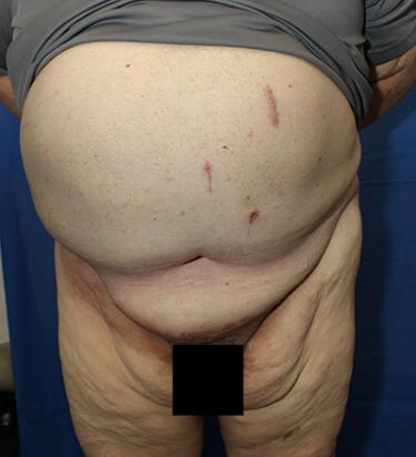 After Results for Panniculectomy